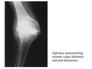 right knee demonstrating
extreme valgus deformity
and joint destruction.
 