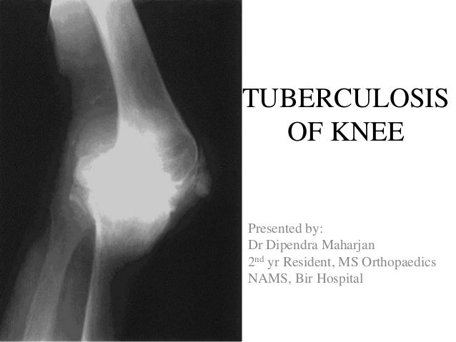 Tuberculosis of Knee Joint - Diagnosis and Treatment 