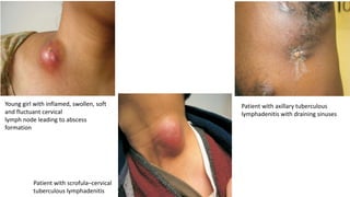 Young girl with inflamed, swollen, soft
and fluctuant cervical
lymph node leading to abscess
formation
Patient with scrofula–cervical
tuberculous lymphadenitis
Patient with axillary tuberculous
lymphadenitis with draining sinuses
 