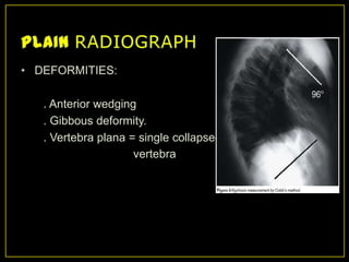 • DEFORMITIES:

   . Anterior wedging
   . Gibbous deformity.
   . Vertebra plana = single collapsed
                     vertebra
 