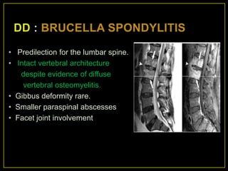 • Predilection for the lumbar spine.
• Intact vertebral architecture
   despite evidence of diffuse
    vertebral osteomyelitis.
• Gibbus deformity rare.
• Smaller paraspinal abscesses
• Facet joint involvement
 