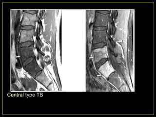 Central type TB
 