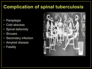 •   Paraplegia
•   Cold abscess
•   Spinal deformity
•   Sinuses
•   Secondary infection
•   Amyloid disease
•   Fatality
 