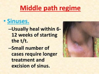 Tuberculosis of spine Slide 66