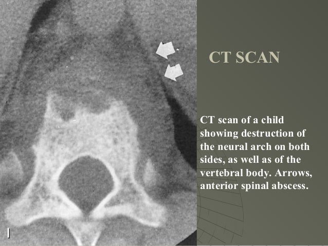 Tuberculosis of spine and its complications nishanth Tuberculosis of spine and its complications nishanth