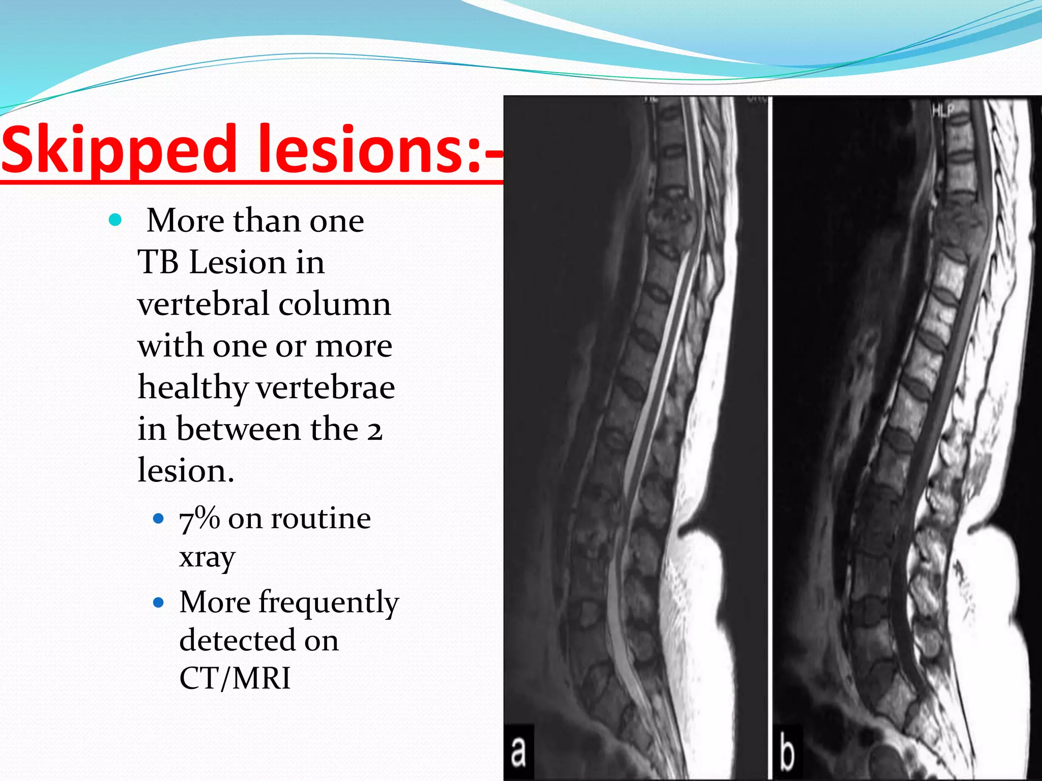 Tuberculosis of spine (pott’s spine)