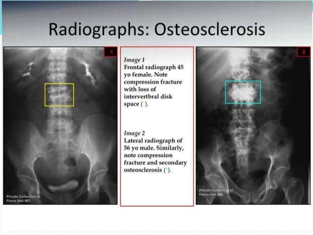 Image result for osteosclerosis vertebrae column
