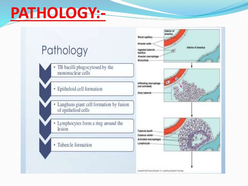 Tuberculosis of spine (pott’s spine)