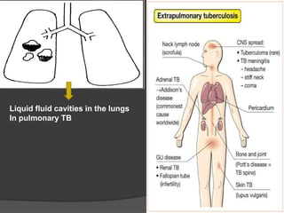 Liquid fluid cavities in the lungs
In pulmonary TB
 
