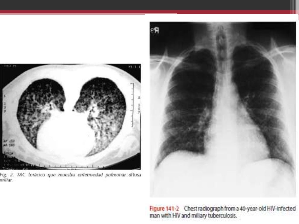 Tuberculosis Pleural