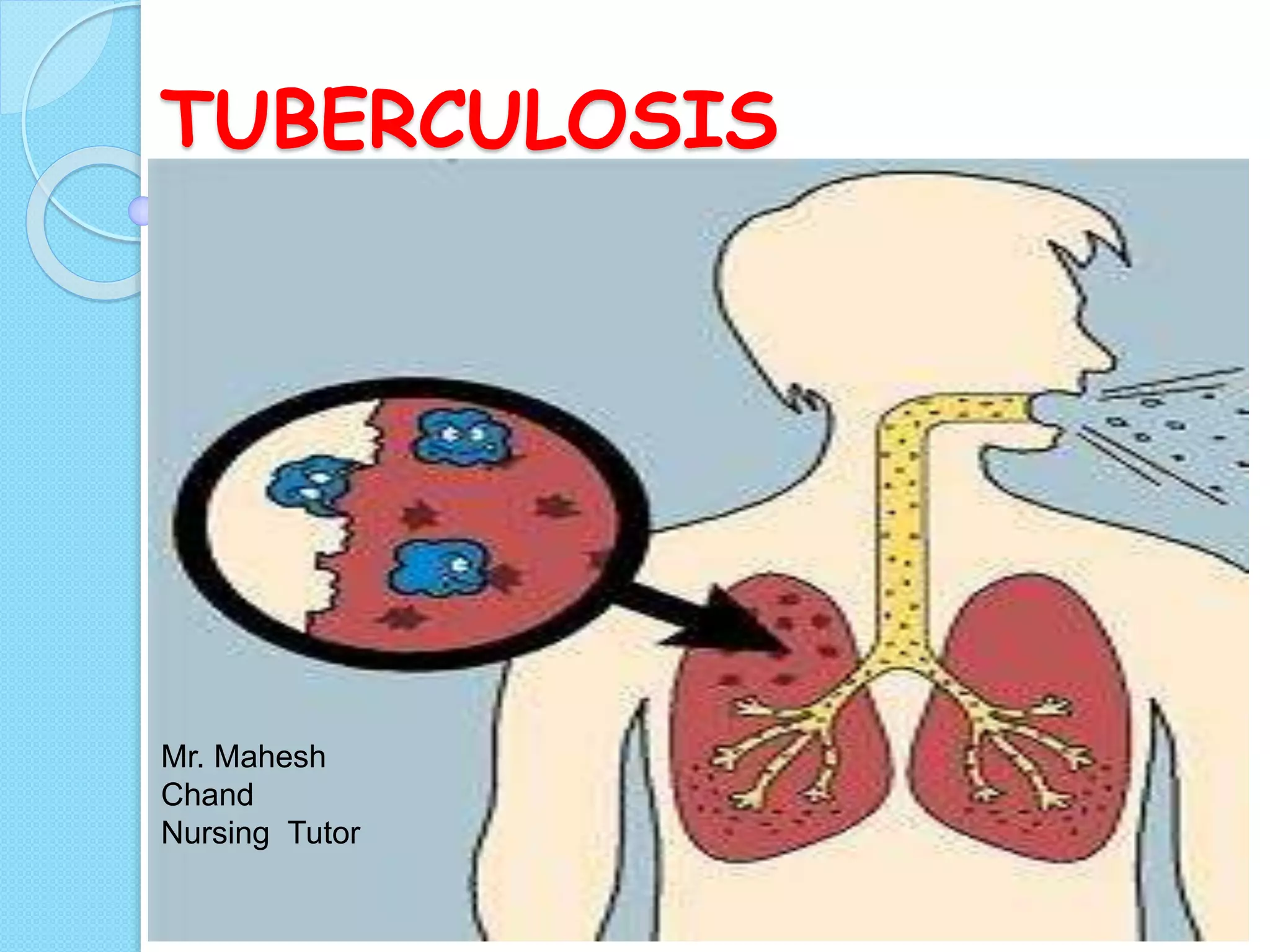 Tuberculosis ppt | PPTX