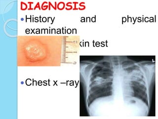 DIAGNOSIS
History and physical
examination
Tuberculin skin test
Chest x –ray
 