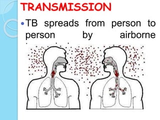 TRANSMISSION
TB spreads from person to
person by airborne
transmission
 