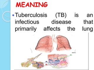 MEANING
Tuberculosis (TB) is an
infectious disease that
primarily affects the lung
parenchyma .
 