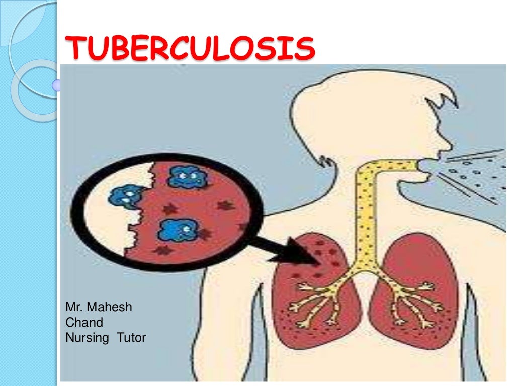 Tuberculosis ppt Tuberculosis ppt