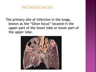 The primary site of infection in the lungs,
known as the “Ghon focus” located in the
upper part of the lower lobe or lower part of
the upper lobe.
 