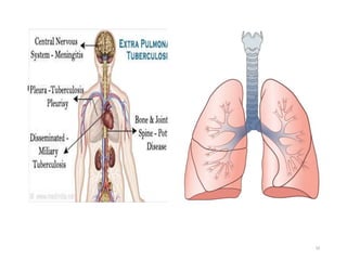 Extra pulmonary Pulmonary
10
 