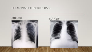 PULMONARY TUBERCULOSIS
CD4 > 200 CD4 < 200
 