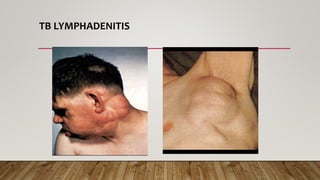 TB LYMPHADENITIS
 