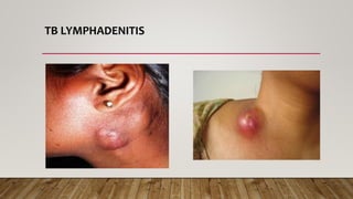 TB LYMPHADENITIS
 