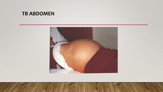 TB ABDOMEN
 