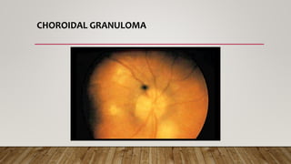 CHOROIDAL GRANULOMA
 