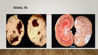 RENAL TB
 