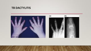 TB DACTYLITIS
 