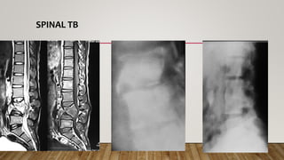 SPINAL TB
 