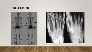 TB Arthritis
SKELETAL TB
 