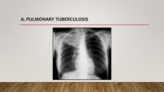 A. PULMONARY TUBERCULOSIS
 