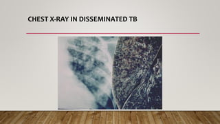 CHEST X-RAY IN DISSEMINATED TB
 