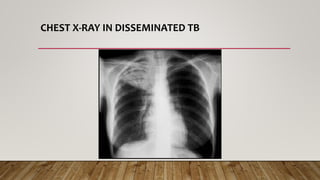 CHEST X-RAY IN DISSEMINATED TB
 