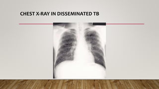 CHEST X-RAY IN DISSEMINATED TB
 