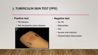 7. TUBERCULIN SKIN TEST (PPD)
• Positive test
• TB infection
• Not necessarily active disease
• Negative test
• No TB
• Malnutrition
• HIV
• Severe viral infection
• Disseminated tuberculosis
 