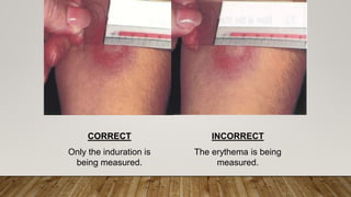 CORRECT
Only the induration is
being measured.
INCORRECT
The erythema is being
measured.
 
