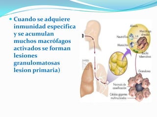  Cuando se adquiere
 inmunidad especifica
 y se acumulan
 muchos macrófagos
 activados se forman
 lesiones
 granulomatosas
 lesion primaria)
 