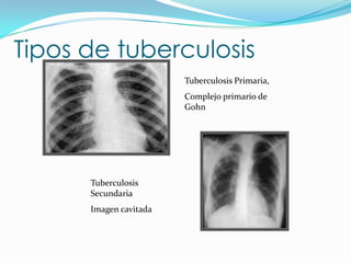 Tipos de tuberculosis
                        Tuberculosis Primaria,
                        Complejo primario de
                        Gohn




      Tuberculosis
      Secundaria
      Imagen cavitada
 