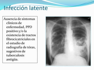 Infección latente
Ausencia de síntomas
 clínicos de
 enfermedad, PPD
 positivo y/o la
 existencia de tractos
 fibrocicatriciales en
 el estudio de
 radiografía de tórax,
 sugestivos de
 tuberculosis
 antigüa.
 