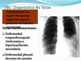 TBC: Diagnóstico:Rx Tórax
  Compromete con
  mayor frecuencia
  segmento apical o
  posterior de lóbulos
  superiores.
Otras manifestaciones:
1) Enfermedad
   traqueobronquial:
   Atelectasias o
   hiperinsuflación
   secundaria.
2) Enfermedad pleural:
   derrame de tamaño
 