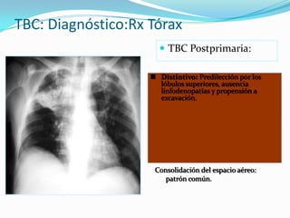 TBC: Diagnóstico:Rx Tórax
                       TBC Postprimaria:

                     Distintivo: Predilección por los
                      lóbulos superiores, ausencia
                      linfodenopatías y propensión a
                      excavación.




                     Consolidación del espacio aéreo:
                        patrón común.
 