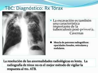 TBC: Diagnóstico: Rx Tórax

                                  La excavación es también
                                   una característica
                                   importante de la
                                   tuberculosis post-primaria.
                                              Cavernas

                                  Mezcla de patrones radiográficos:
                                   opacidades lineales, reticulares y
                                   nodulares.




La resolución de las anormalidades radiológicas es lenta. La
  radiografía de tórax no es el mejor método de vigilar la
  respuesta al tto. ATB.
 