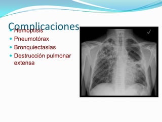 Complicaciones
 Hemoptisis
 Pneumotórax
 Bronquiectasias
 Destrucción pulmonar
 extensa
 