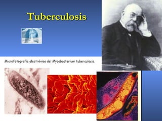 TuberculosisTuberculosis
 