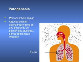 • Persona inhale gotitas
• Algunos pueden
alcanzar los sacos de
aire pequeños del
pulmón (los alvéolos),
donde comienza la
infección
Patogénesis
Alveolos
 