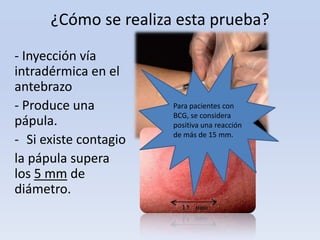 ¿Cómo se realiza esta prueba?
- Inyección vía
intradérmica en el
antebrazo
- Produce una
pápula.
- Si existe contagio
la pápula supera
los 5 mm de
diámetro.

Para pacientes con
BCG, se considera
positiva una reacción
de más de 15 mm.

 
