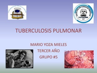 TUBERCULOSIS PULMONAR
MARIO YOZA MIELES
TERCER AÑO
GRUPO #5
 