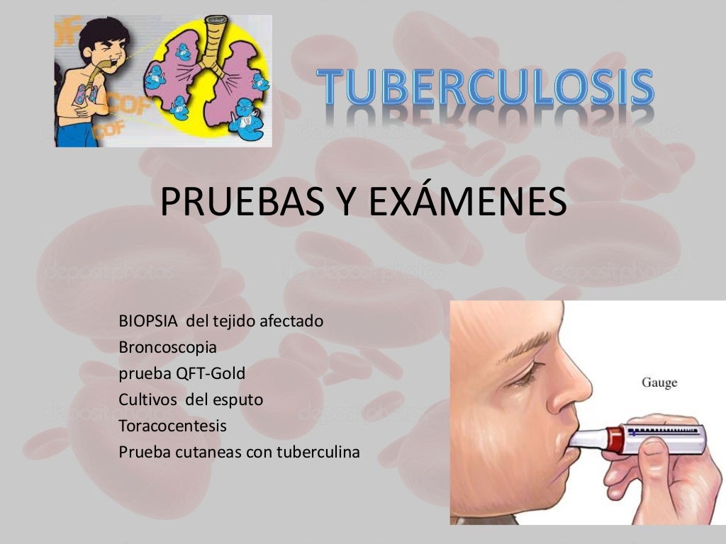 Tuberculosis pulmonar Tuberculosis pulmonar
