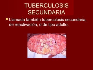 TUBERCULOSIS
SECUNDARIA
 Llamada también tuberculosis secundaria,
de reactivación, o de tipo adulto.
 