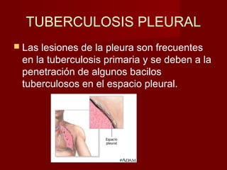TUBERCULOSIS PLEURAL
 Las lesiones de la pleura son frecuentes
en la tuberculosis primaria y se deben a la
penetración de algunos bacilos
tuberculosos en el espacio pleural.
 